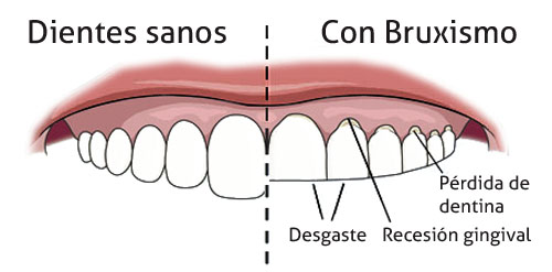 Fisioterapia cráneo-mandibular ¿qué es? 2 Bruxismo