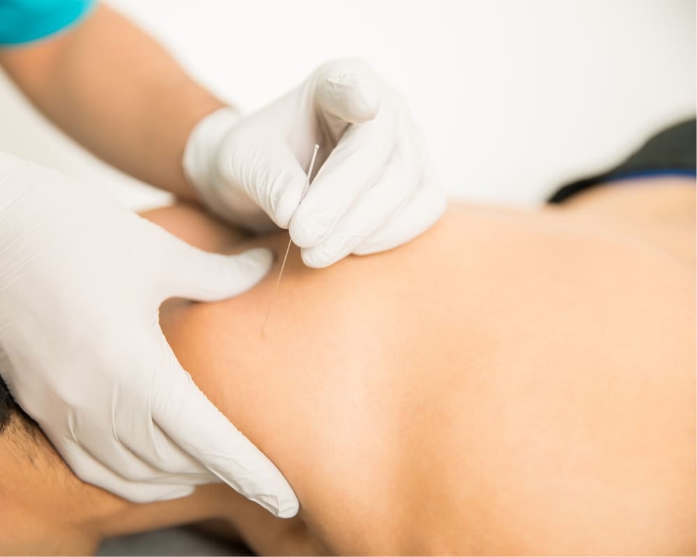 Punción seca ¿qué es? 5 La punción seca como técnica fisioterápica