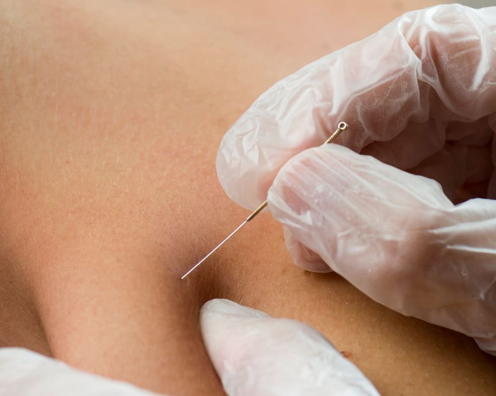 Punción seca ¿qué es? 1 Qué es la punción seca