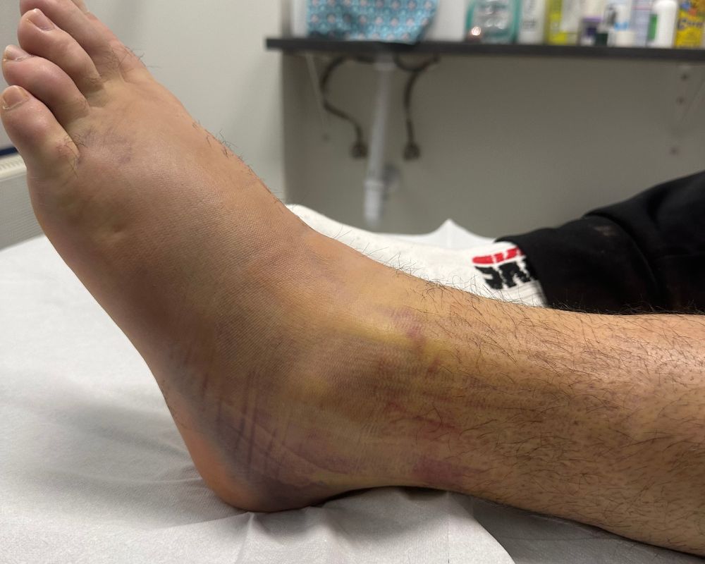 Fisioterapia postquirúrgica 5 Prevención con la fisioterapia postquirúrgica