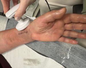 Tratamiento de cicatrices con fisioterapia postquirúrgica