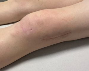 Fisioterapia postquirúrgica 4 tratamiento cicatrices fisioterapia quirurgica 02