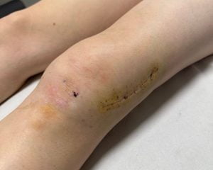 tratamiento cicatrices fisioterapia quirurgica 03