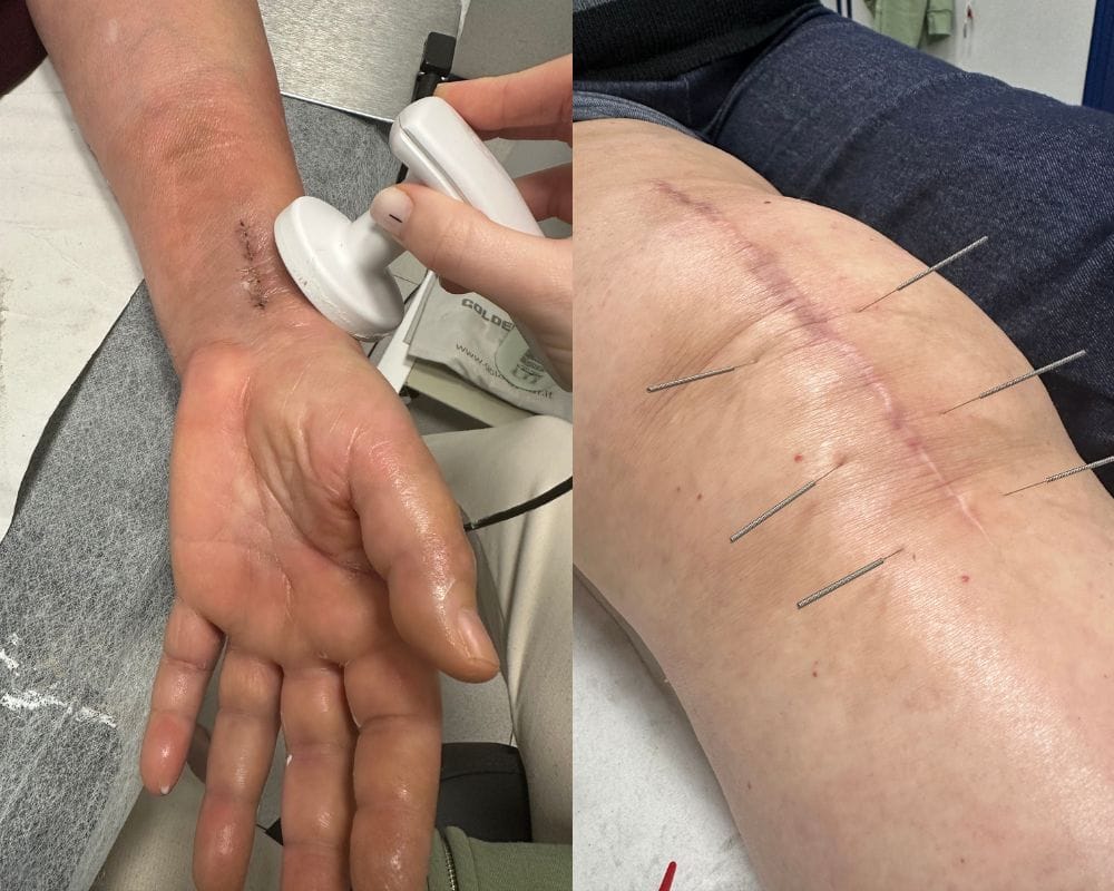 Aplicación de diatermia en brazo y punción seca en pierna