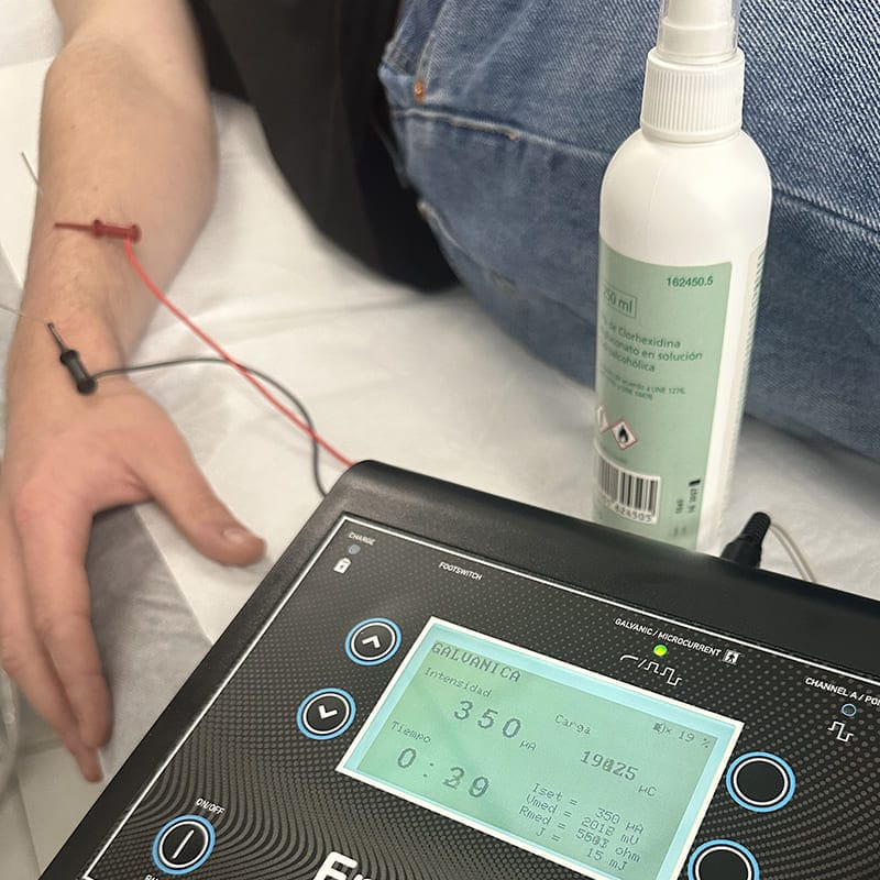 Electrolisis percutánea intratisular