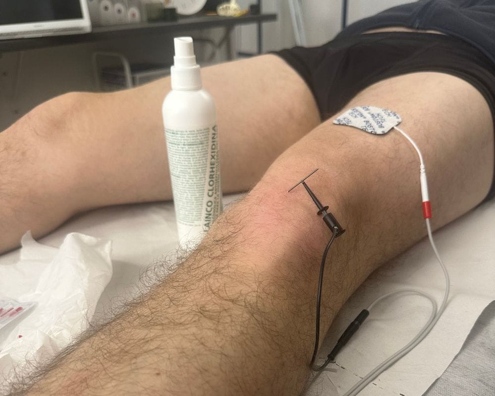 Electrólisis percutánea en fisioterapia