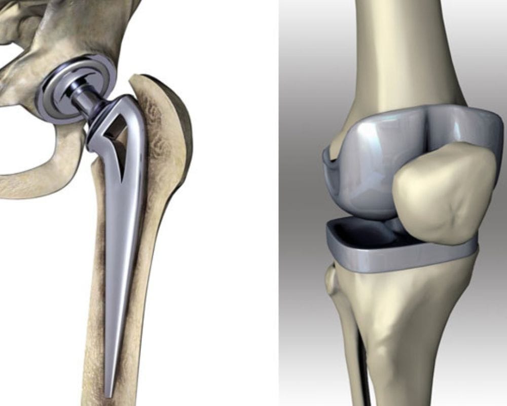 Prótesis de cadera y rodilla
