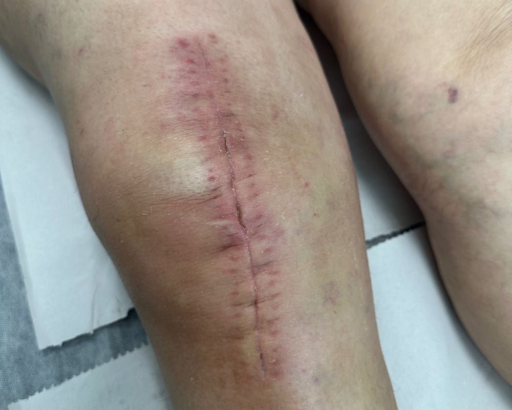 Rehabilitación para prótesis de rodilla