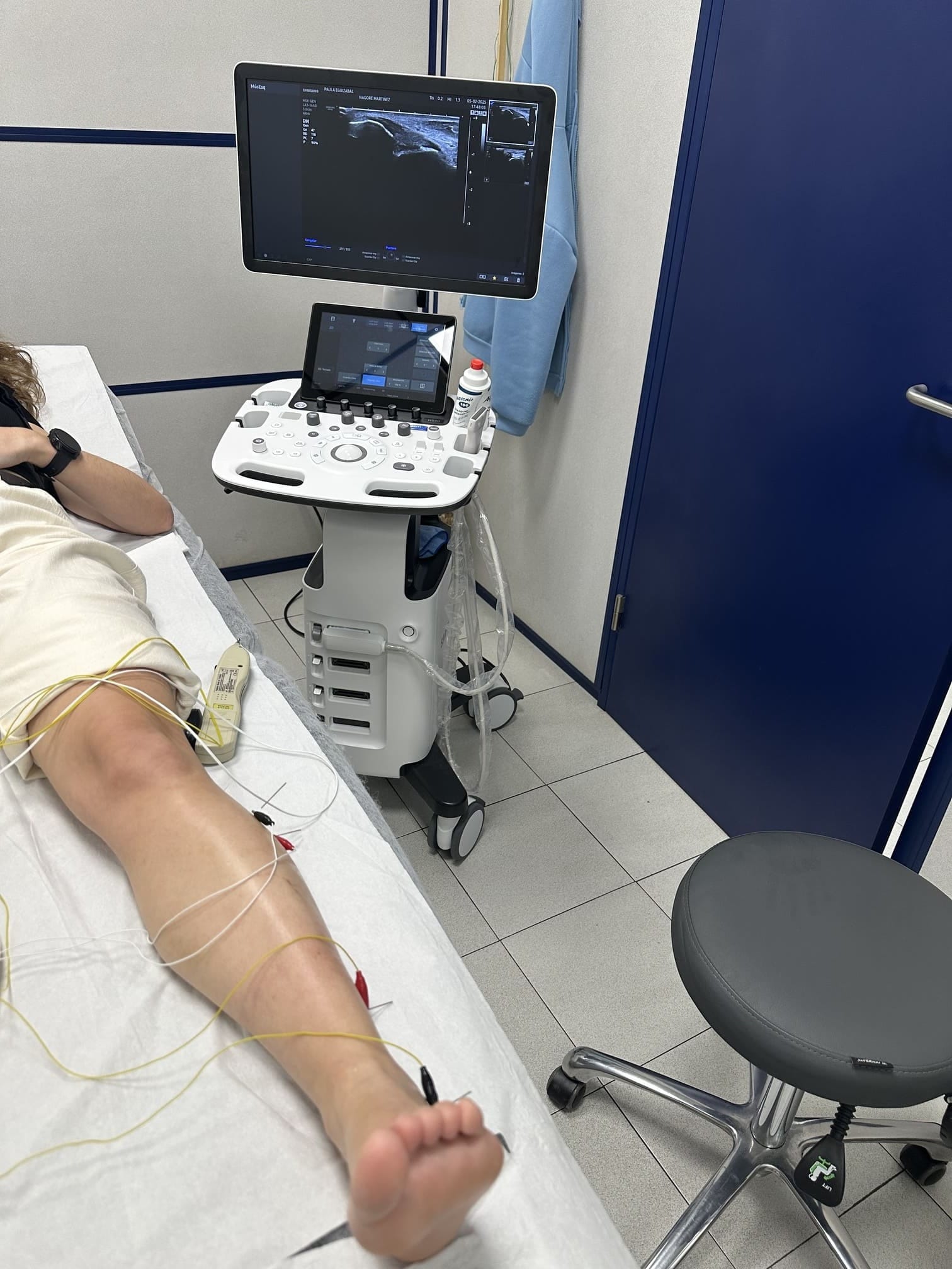 Cómo es el proceso de neuromodulación percutánea