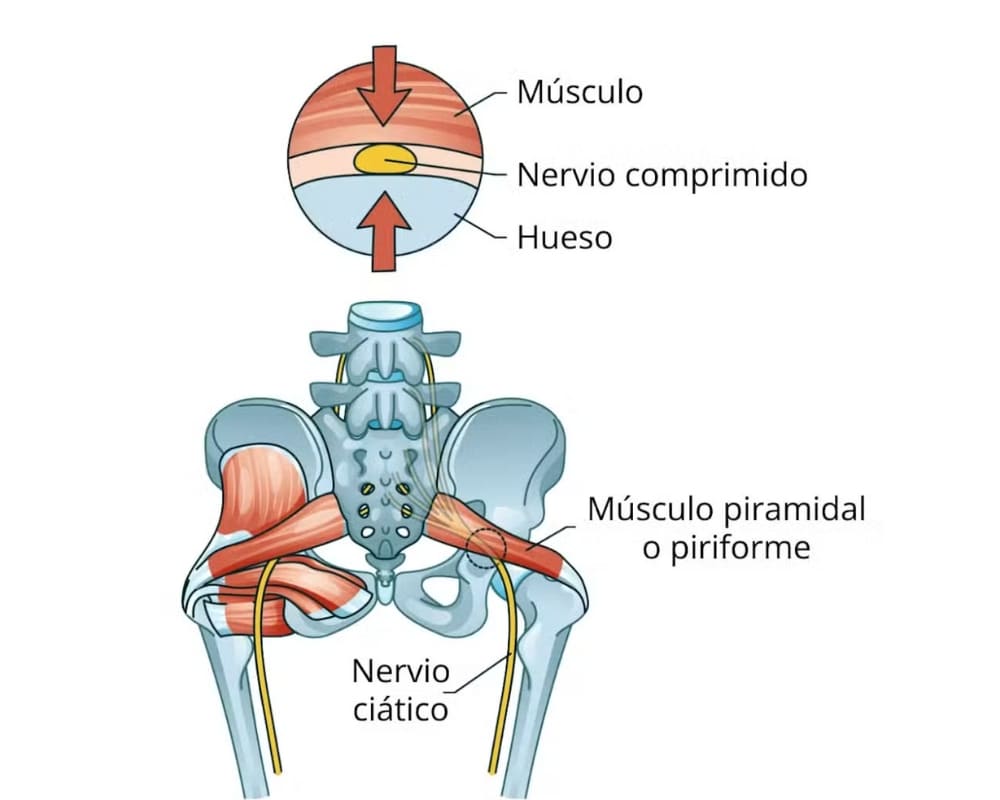 Síndrome del piramidal 1 El síndrome piramidal o falsa ciática
