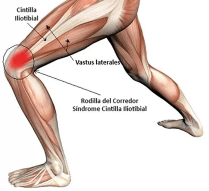 Síndrome de la cintilla iliotibial o rodilla del corredor 1 Ciintilla iliotibial